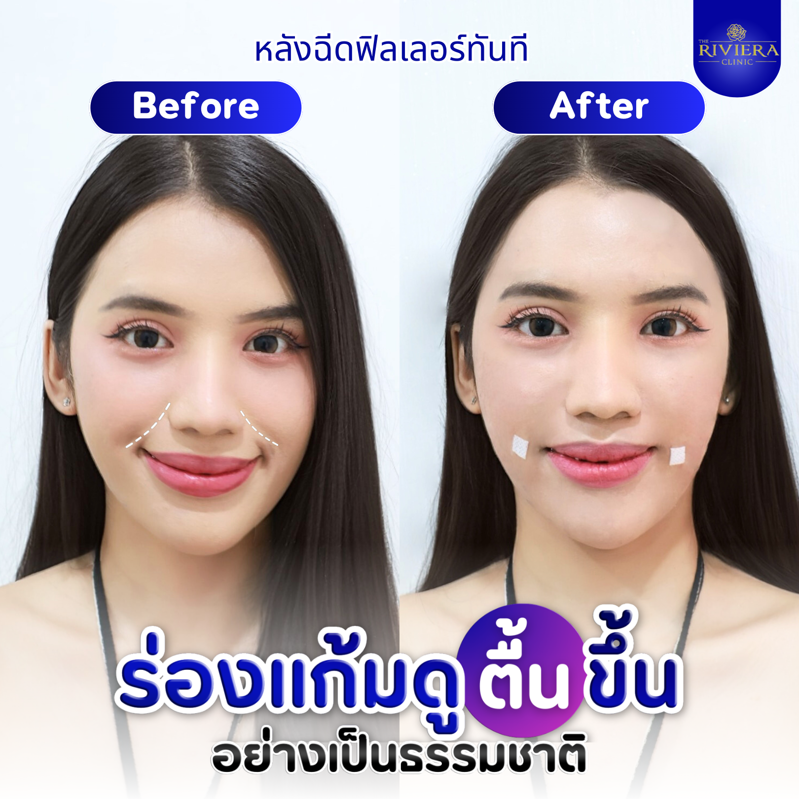 ฟิลเลอร์ ชลบุรี
